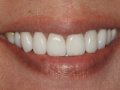 post tx porcelain veneers  1600x1200  opt