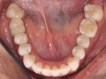 post tx resin fillings  1600x1200  opt